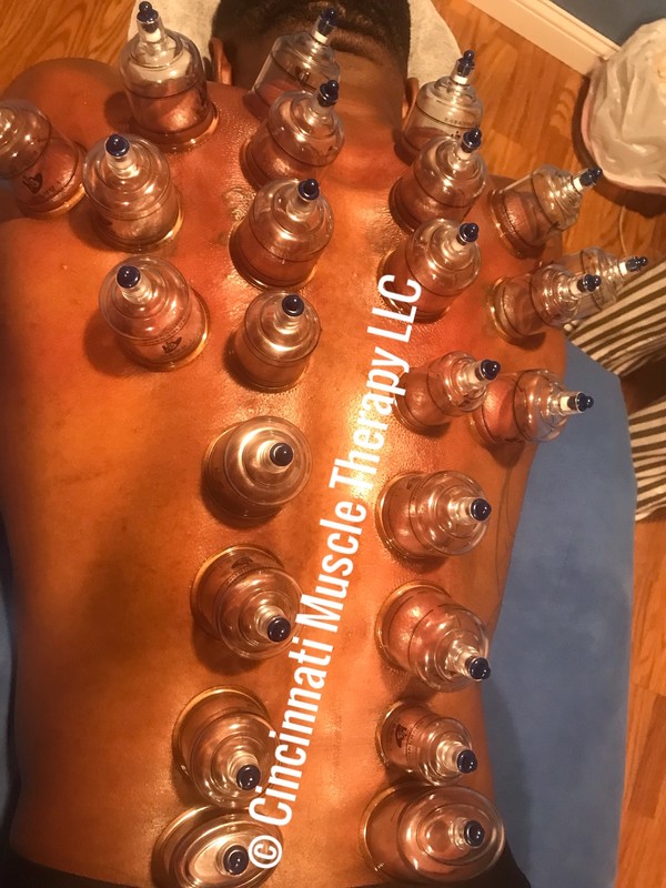 Cupping Therapy on Pro Bodybuilder preparing him for competition